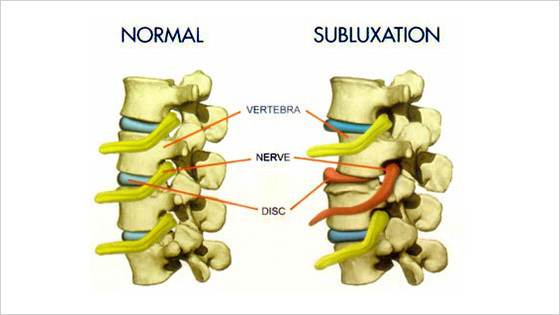 Vertebral Subluxation